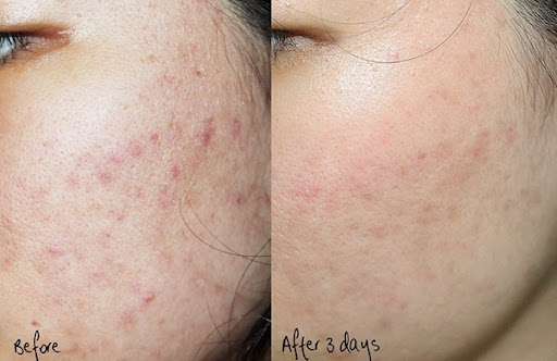 Dịch vụ điều tri thâm da mặt uy tí,chất lượng và hiệu quả tại Green Field spa